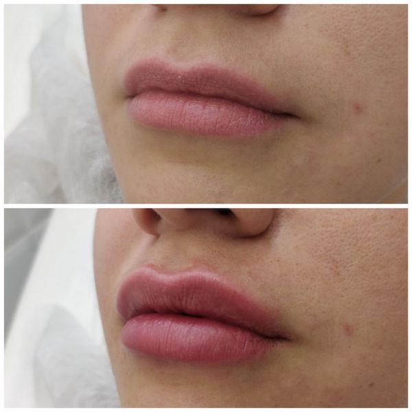 Увеличение маленьких губ до и после фото